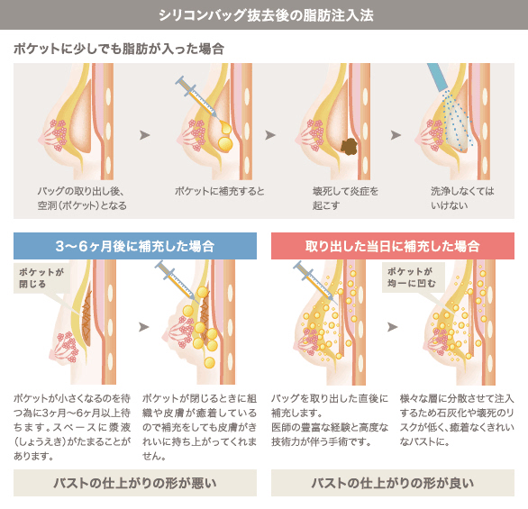 シリコンバッグ除去後の脂肪注入豊胸