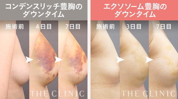 コンデンスビブラ豊胸｜THE CLINIC （ザクリニック）【公式】