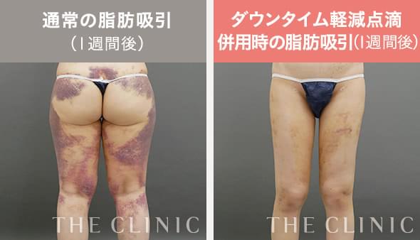 脂肪吸引｜美容外科のTHE CLINIC