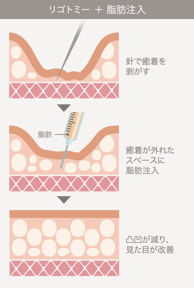 脂肪吸引の失敗修正【顔／お腹／太もも／お尻／ふくらはぎ】｜ザ