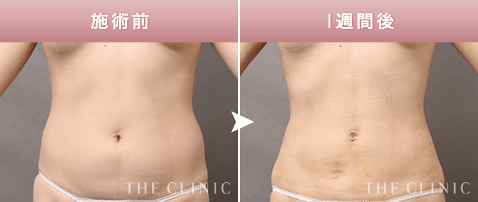 THE CLINIC の術後ケア【脂肪吸引後のダウンタイムを軽減】