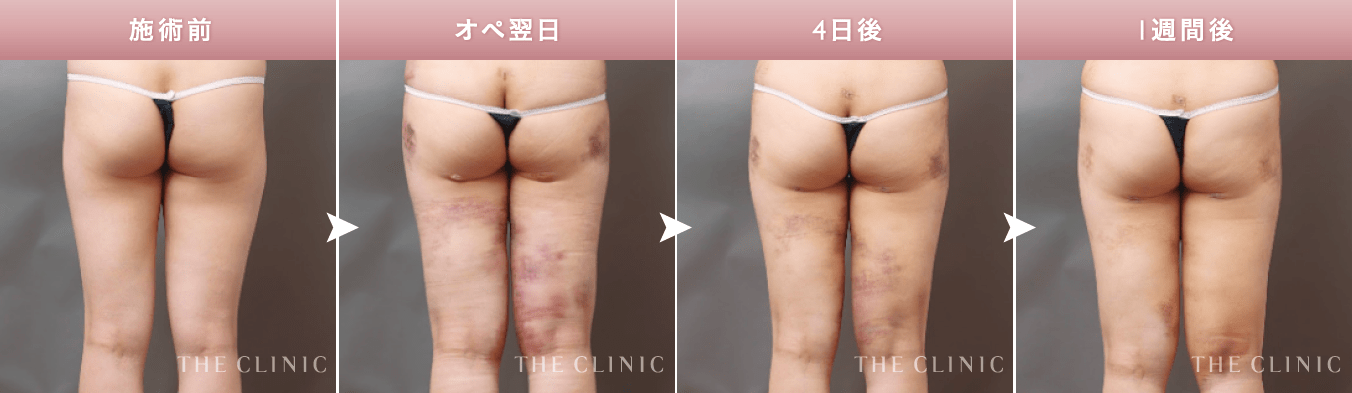 THE CLINIC の術後ケア【脂肪吸引後のダウンタイムを軽減】