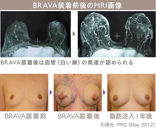 BRAVA×コンデンスリッチ豊胸｜THE CLINIC【公式】