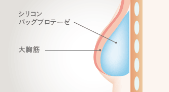 シリコンバッグプロテーゼ / 大胸筋