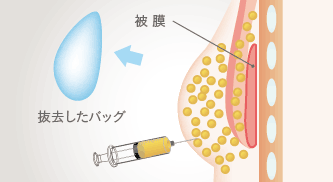 被膜 / 抜去したバッグ