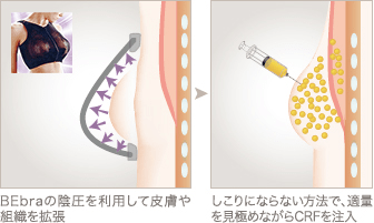 BEbraの陰圧を利用して皮膚や組織を拡張 / しこりにならない方法で、適量を見極めながらCRFを注入