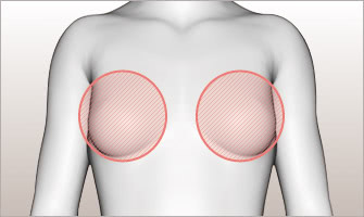 放射線治療後のバストは、皮膚やその周辺組織が弱くなったり、伸びにくくなったりと、ある種特異な状態を呈するものです。こうしたことを考慮して、最善の解決策をご提示します。