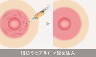 脂肪やヒアルロン酸を注入