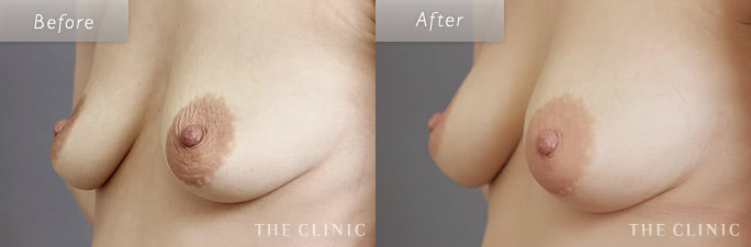 乳輪のしわ・しぼみ改善の症例画像1