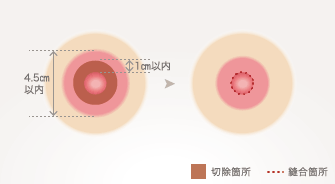 術前の直径が4.5㎝以内、または切除幅が1㎝以内の場合に適しています。