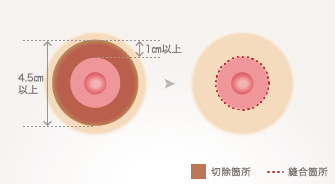術前の直径が 4.5㎝以上、または切除幅が1㎝以上の場合に適しています。