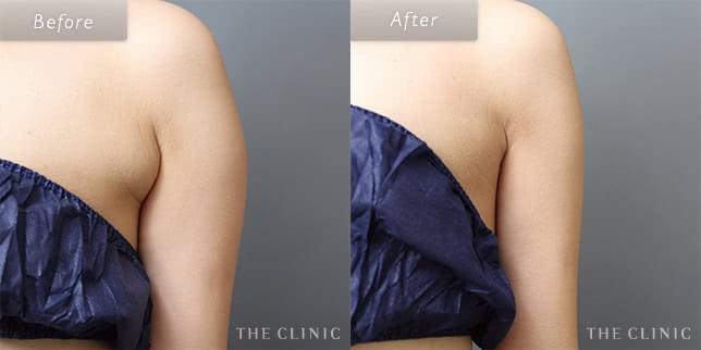 脂肪吸引・痩身 脇肉 症例写真