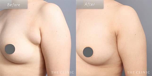 脂肪吸引・痩身 脇肉 症例写真