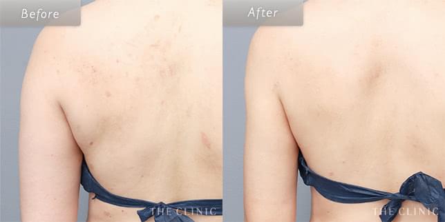 脂肪吸引・痩身 脇肉 症例写真