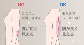 NG: ここだけ吸引しすぎると腕が短く見える / OK: 根元までしっかり吸引すると腕が長く見える