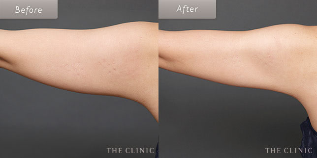 脂肪吸引・痩身 二の腕 症例写真