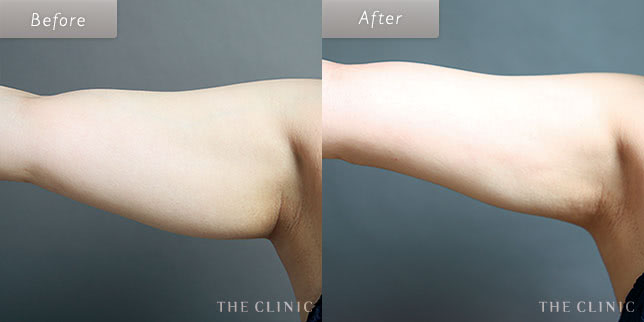 脂肪吸引・痩身 二の腕 症例写真