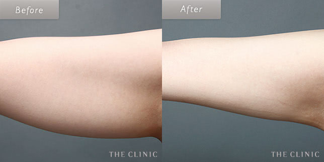 脂肪吸引・痩身 二の腕 症例写真