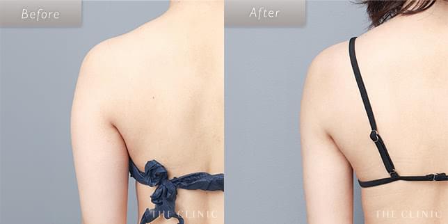 脂肪吸引・痩身 二の腕・肩 症例写真