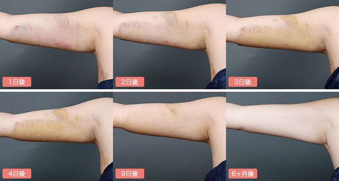 二の腕のダウンタイム