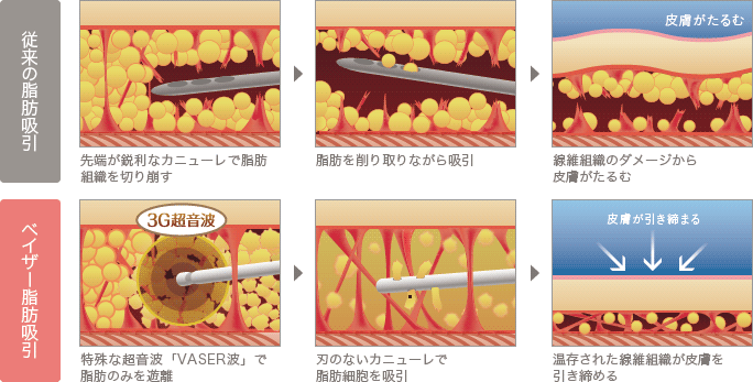 従来の脂肪吸引: 先端が鋭利なカニューレで脂肪組織を切り崩す / 脂肪を削り取りながら吸引 / 線維組織のダメージから皮膚がたるむ | ベイザー脂肪吸引: 特殊な超音波「VASER波」で脂肪のみを遊離 / 刃のないカニューレで脂肪細胞を吸引 / 温存された線維組織が皮膚を引き締める