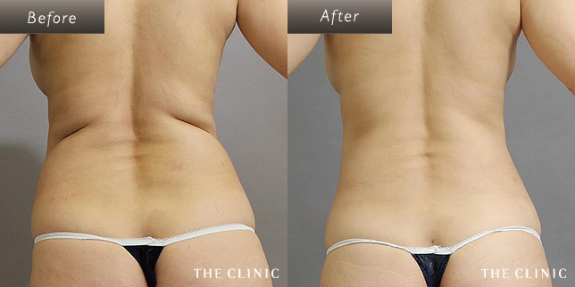 女性(46歳)背中のベイザー脂肪吸引の症例写真