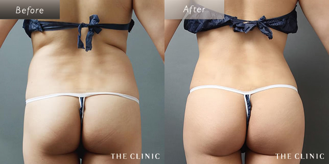 女性(50歳)背中のベイザー脂肪吸引の症例写真