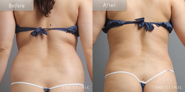 女性(40歳)背中のベイザー脂肪吸引の症例写真