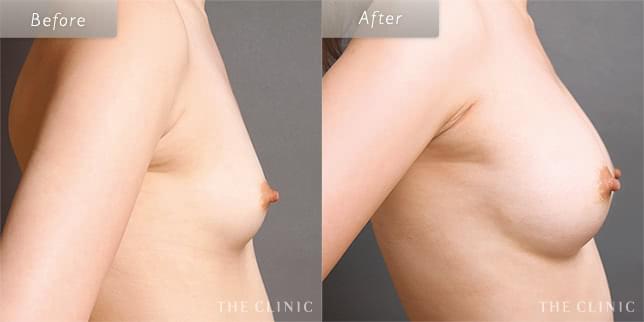 豊胸手術・バストアップの29歳女性の症例写真