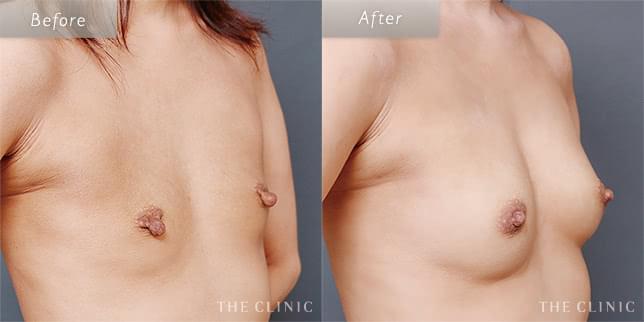 豊胸手術・バストアップの43歳女性の症例写真