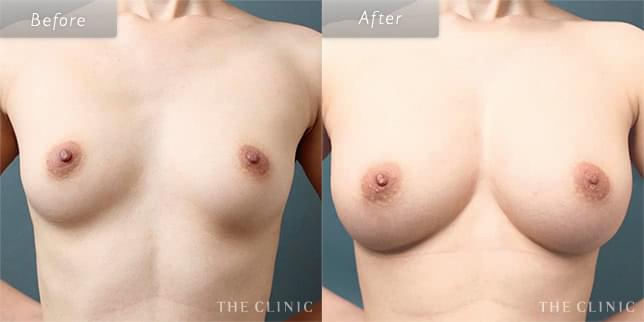 豊胸手術・バストアップの29歳女性の症例写真