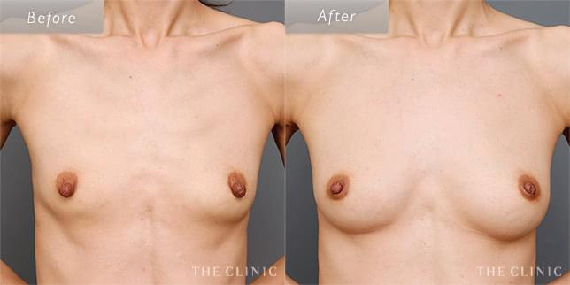 豊胸手術・バストアップの41歳女性の症例写真