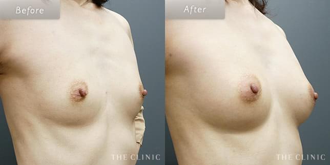 豊胸手術・バストアップの49歳女性の症例写真