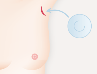 シリコンバッグ豊胸