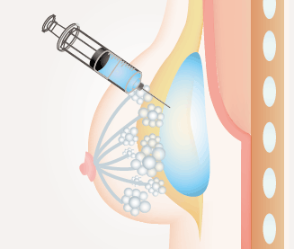 ヒアルロン酸豊胸