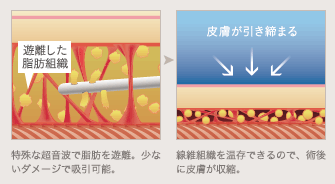 特殊な超音波で脂肪を遊離。少ないダメージで吸引可能。 / 線維組織を温存できるので、術後に皮膚が収縮。