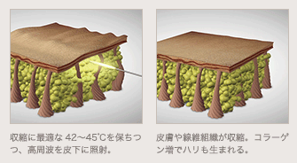 収縮に最適な42〜45℃を保ちつつ、高周波を皮下に照射。 / 皮膚や線維組織が収縮。コラーゲン増でハリも生まれる。