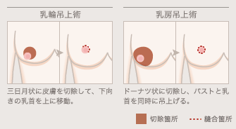 乳輪吊上術: 三日月状に皮膚を切除して、下向きの乳首を上に移動。 / 乳房吊上術: ドーナツ状に切除し、バストと乳首を同時に吊上げる。