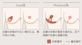 Goes法: 皮膚の余剰が少ない場合には、楕円形に切除。 / Mckissock法: 皮膚の余剰が重度の場合は、皮下組織や乳腺も適量切除。