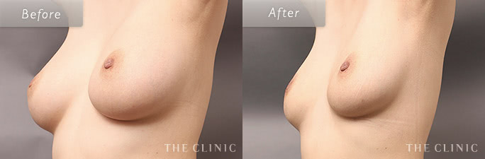 乳房縮小術の症例画像1