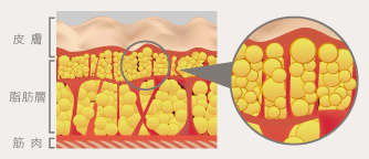 セルライトの皮膚/脂肪層/筋肉のイメージ