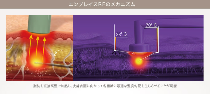 エンブレイスRFのメカニズム|脂肪を直接高温で加熱し、皮膚表面に向かって各組織に最適な温度勾配を生じさせることが可能