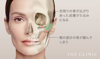 目周りの骨が広がり余った皮膚がたるみになる / 頬の部分の骨が縮んでしまう