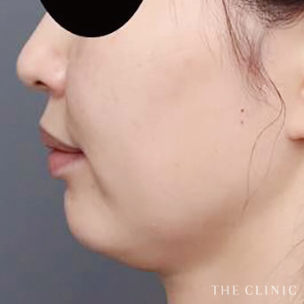 頰/顎のベイザー脂肪吸引のモニター(40代)術前症例画像