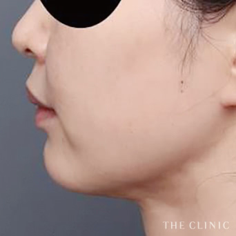 頰/顎のベイザー脂肪吸引のモニター(40代)術前症例画像