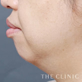 頰/顎のベイザー脂肪吸引+レヌビオンのモニター(50代)術前症例画像