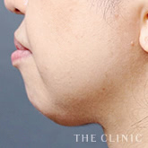 頰/顎のベイザー脂肪吸引+レヌビオンのモニター(50代)術前症例画像