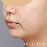 頰/顎のベイザー脂肪吸引のモニター(20代)術前症例画像