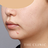 頰/顎のベイザー脂肪吸引のモニター(20代)術前症例画像