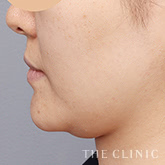 頰/顎のベイザー脂肪吸引のモニター(30代)術前症例画像